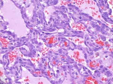 乳房高级别血管肉瘤(cqz-22)图9
