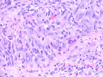 乳房高级别血管肉瘤(cqz-22)图10