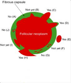 甲状腺滤泡癌的包膜侵犯图1