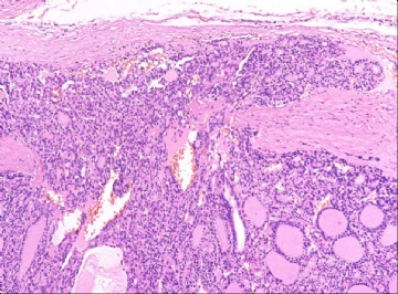 甲状腺滤泡癌的包膜侵犯图4