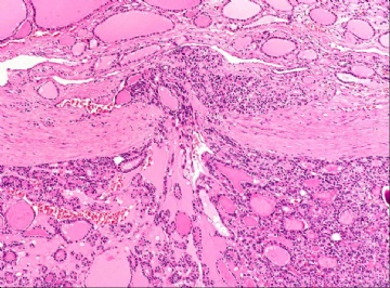 甲状腺滤泡癌的包膜侵犯图6