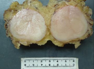 看大体猜诊断--胸壁肿物-皮隆突（已确诊）（4）图1
