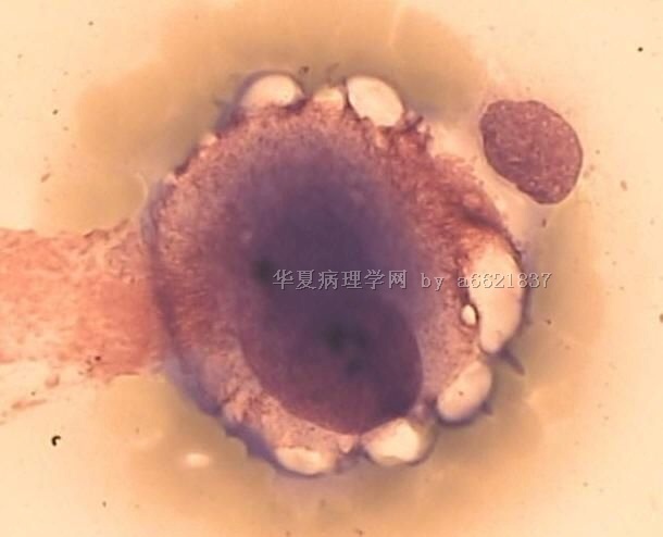 腹股沟肿物穿刺涂片图2