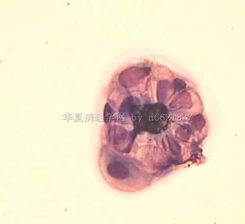 腹股沟肿物穿刺涂片图12