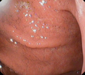 胃窦部病变图1