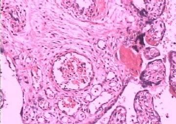 请教各同仁、专家，胎盘病理！！图11
