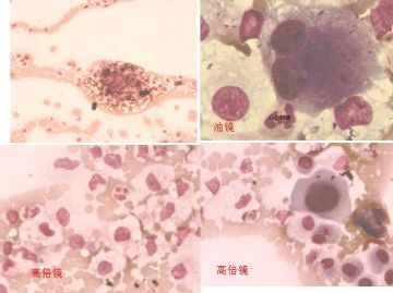 25 男性 大量血性细胞积液 是什么性质的心包积液？图1