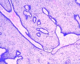 请指点迷津:乳腺纤维腺瘤还是良性叶状肿瘤?图4