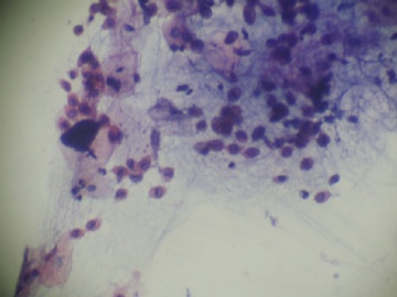 痰涂片（TCT）图1