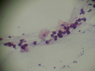 痰涂片（TCT）图5