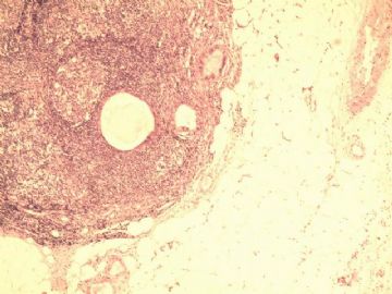 淋巴结腺体异位？图1