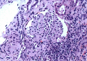 Woman with acute renal failure图1