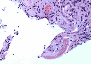 Woman with acute renal failure图2