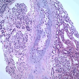 Woman with acute renal failure图3