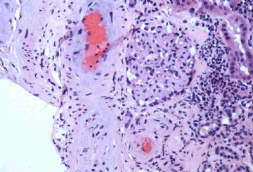 Woman with acute renal failure图4