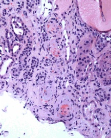 Woman with acute renal failure图5