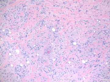 浸润性导管癌伴大汗腺特征,morphology like histiocytoid or granular cell tumor (cqz-24) 7-16-2009图1