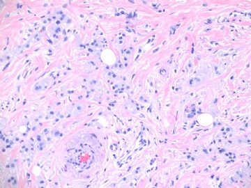浸润性导管癌伴大汗腺特征,morphology like histiocytoid or granular cell tumor (cqz-24) 7-16-2009图2