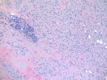浸润性导管癌伴大汗腺特征,morphology like histiocytoid or granular cell tumor (cqz-24) 7-16-2009图3