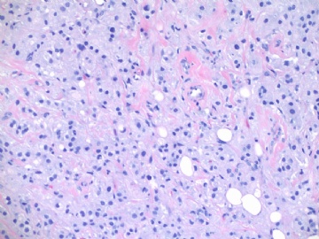 浸润性导管癌伴大汗腺特征,morphology like histiocytoid or granular cell tumor (cqz-24) 7-16-2009图4