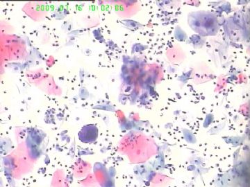 TCT：HPV？图3