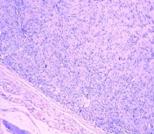 大腿梭形细胞肿瘤图1