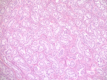 Sharing some photos of ovarian pure sertoli cell tumors图1