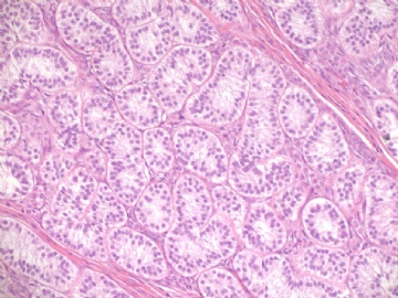 Sharing some photos of ovarian pure sertoli cell tumors图2