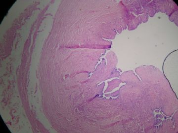 请教：输卵管系膜囊肿囊壁中可出现子宫内膜腺体吗？图1