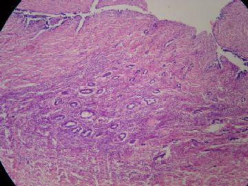 请教：输卵管系膜囊肿囊壁中可出现子宫内膜腺体吗？图3