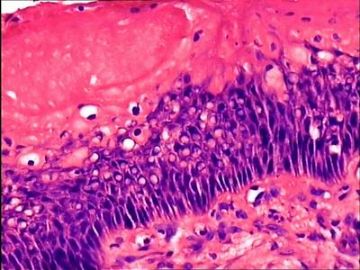 子宫颈鳞状上皮棘层细胞空泡是怎么回事？图4