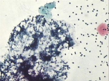 宫颈刮片．４６岁体检图19