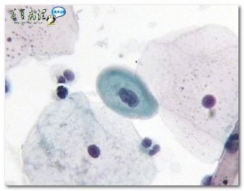 宫颈液基．３５岁．体检图1