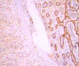 胃肠间叶源性肿瘤，CD117已重做图1