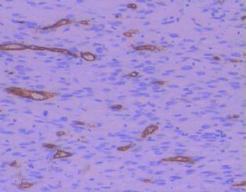 胃肠间叶源性肿瘤，CD117已重做图4