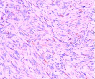 胃肠间叶源性肿瘤，CD117已重做图6
