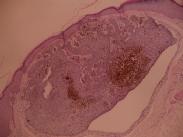 右大腿皮肤肿块图1