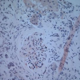61 years old man with proteinuria.图7
