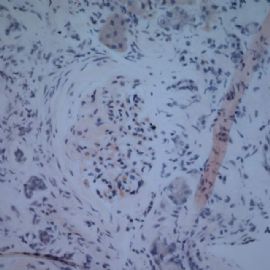 61 years old man with proteinuria.图8