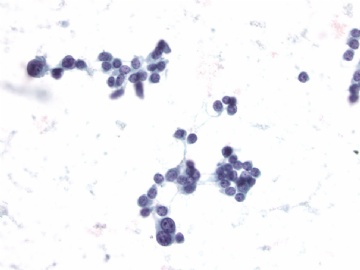 Thyroid FNA图2