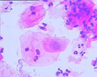 宫颈液基细胞学------已有活检结果图6