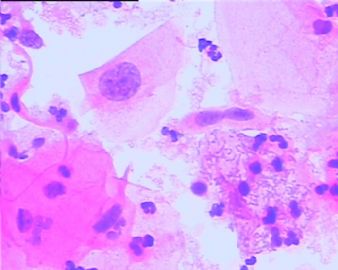 宫颈液基细胞学------已有活检结果图12