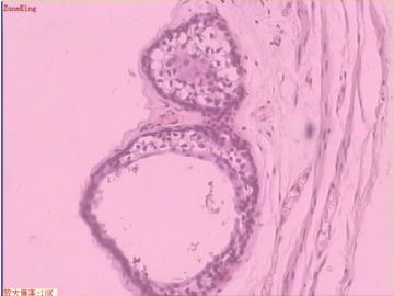 子宫内膜癌 输卵管及卵巢浆膜肿物图1