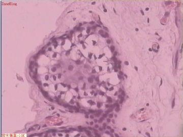 子宫内膜癌 输卵管及卵巢浆膜肿物图2