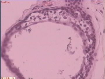 子宫内膜癌 输卵管及卵巢浆膜肿物图3