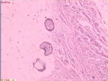 子宫内膜癌 输卵管及卵巢浆膜肿物图4