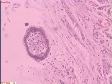 子宫内膜癌 输卵管及卵巢浆膜肿物图5