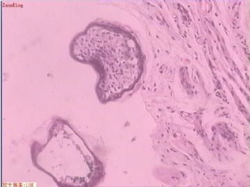 子宫内膜癌 输卵管及卵巢浆膜肿物图6