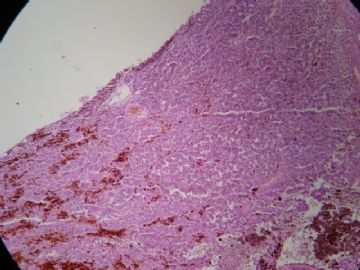 右胸壁黑色素瘤图8