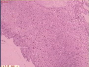 宫颈活检组织图3